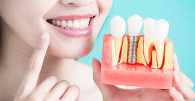 Mit kell tudni a fogimplantátumokról?